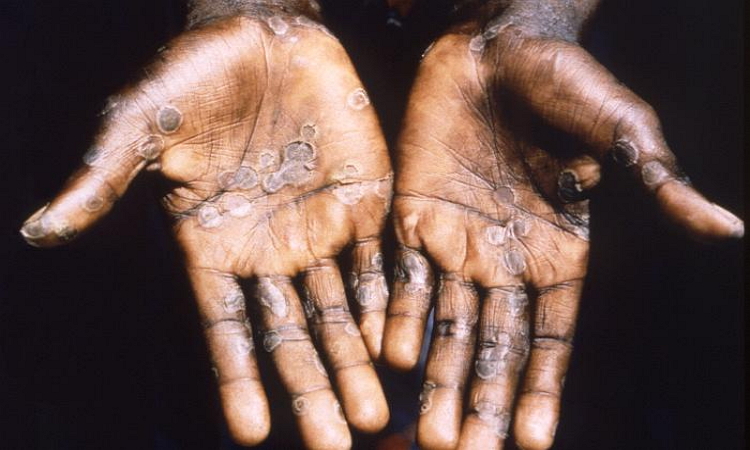 Monkeypox on skin picture